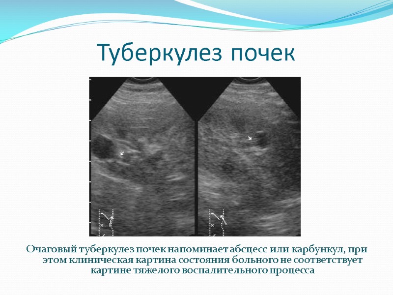 Туберкулез почек Очаговый туберкулез почек напоминает абсцесс или карбункул, при этом клиническая картина состояния